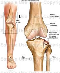 In Case You Were Wondering Tibial Plateau Fracture Knee Fracture Fractures