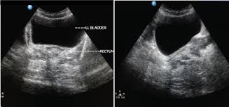 Uterine agenesis or hypoplasia (bilateral) or unicornuate uterus (unilateral). Jcdr Congenital Anomaly Mullerian Agenesis Primary Amenorrhea Psychosis Nos Psychological Distress