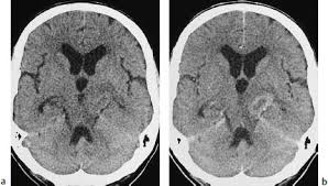 Pet scans are more often used for following treatment, a pet scan may be performed to determine whether tumor tissue remains. Intracranial Tumors Radiology Key