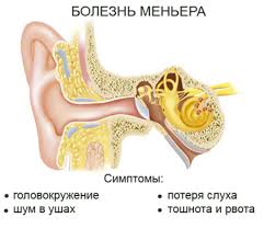 шум в ушах и голове лечение в домашних условиях Bolezn Menera Uho Top