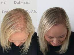 Hair loss solutions for males and females. Scalp Micropigmentation And All You Need To Know Belfast Live