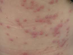 I have drained it once already and i am faithful to shock each week and to keep the bromine tablets i have been told that bromine or chlorine will not kill the bacteria and that i have to drain and refill the tub to get rid of it yet what about bacteria in the. Spa Pool Folliculitis Dermnet Nz