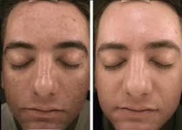 And if you're experiencing any of the above, you might also notice a little discoloration or redness too, says dr. Micro Needling With Prp Services Medispa Physimed