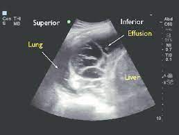 Before pleural ultrasound, a respiratory expert (gh) reviewed each patient's most recent chest radiographs to determine which side of the thorax to assess via ultrasound. Ultrasound Of A Septated Pleural Effusion This Ultrasound Was Taken Download Scientific Diagram