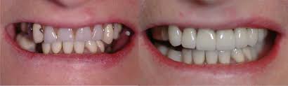 Image result for dental implants