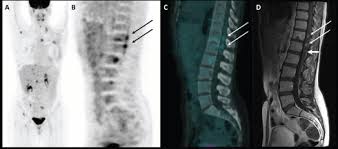 Cancer cells tend to be more active than normal cells. Intramedullary Spinal Cord Metastases From Breast Cancer Detection With 18f Fdg Pet Ct Ecancer