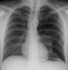 Image result for Open Pneumothorax