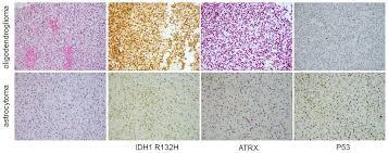 Transcribed image text from this question. Cancers Free Full Text Clinical Management Of Diffuse Low Grade Gliomas Html