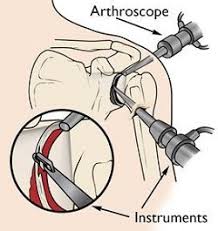 Image result for Scapulothoracic Injection