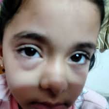 We did not find results for: My Son Was Bitten By A Mosquito Insect In The Morning On His Eyelid And His Eye Has Swollen Up His Eye Looks Chinky What Should I Do For The Swelling Till