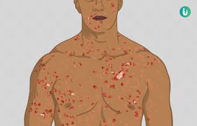 Image result for syphilis symptoms