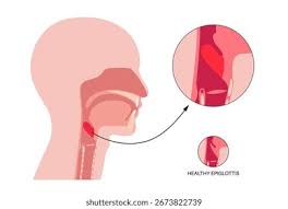 Image result for Epiglottitis
