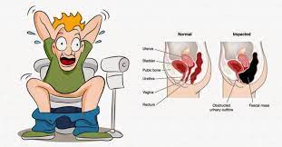 Castor oil can also be taken when you are in dire straits and wishing that your bowels would get cleared. 11 Home Remedies For Constipation