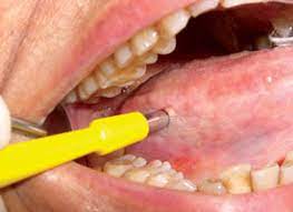 Oral doctor removing wisdom teeth. Oral Soft Tissue Biopsy An Overview Jcda