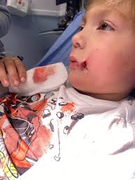 Does this need a stitch? It's from a frisbee. It's kind deep but did stop  bleeding. It did open up again after he rubbed his face