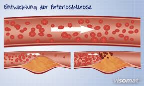 Cholesterin Senken Was Hilft Visomat Blutdruckmessgerate