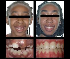 Vemos pacientes de todas las edades! Por lo general, comenzamos a usar  frenos a los 12 años. Sin embargo, también puede hacerse los frenos a los  30 y 40 años. Nuestros precios