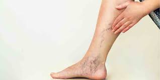 Symptoms include pain and swelling in one leg, chest pain, or numbness on one side of the body. Trombosis Venosa Flebitis Tratamientos Sintomas E Informacion En Cuidateplus