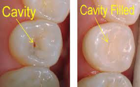It took him 2 weeks to get a refund. okay? Tooth Filling Procedure Cost Cavity Filling Types Nearby Dental
