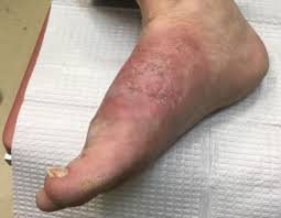 The purpose of this work is to increase the awareness of this infection that is still not diagnosed in our context by moroccan practitioners, as well as to show the medical treatment limits in madura foot. Dermdx Chronic Foot Rash Clinical Advisor