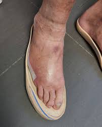 Image result for toe amputation