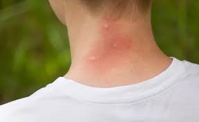 Tick bites are pretty painless and a bit itchy at first, but dangerous, with more symptoms to note: What Bit Me The Ultimate Guide To Common Bites And Stings