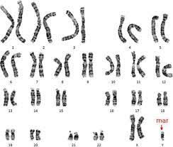Jgm Journal Of Genetic Medicine J Genet Med 1226 1769 2383 8442 Korean Society Of Medical Genetics Korea Jgm 14 043 10 5734 Jgm 2017 14 1 43 Case Report Prenatal Diagnosis Of The Isodicentric Chromosome 22 Associated With Cat Eye Syndrome