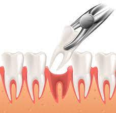 Smoking after tooth extraction