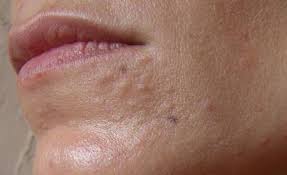Sebaceous glands are attached to hair follicles all over your body. Natural Remedies For Sebaceous Hyperplasia Women Daily Magazine