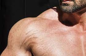 Such treatments show modest success, though they're. How To Avoid Stretch Marks From Weight Lifting Sculptdtla Com