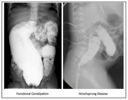 Image result for Functional Encopresis