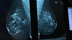 What is ductal carcinoma in situ? Molecular Breast Imaging Offers Doctors A New Tool In Breast Cancer Screenings Prevention 6abc Philadelphia