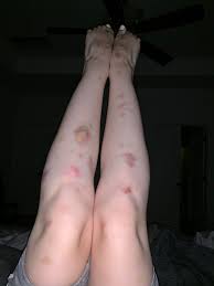 EmiOK on X: Bro. 👽 ouchies t.covXjvcbGyZh  X