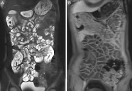 Scielo Brasil Magnetic Resonance Enterography In Pediatric Celiac Disease Magnetic Resonance Enterography In Pediatric Celiac Disease