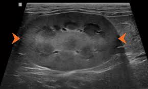 Diffuse Renal Parenchymal Diseases | Radiology Key
