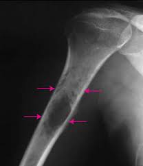 I am very grateful to his kindness and care. Image Ewing Sarcoma Of Bone Msd Manual Consumer Version