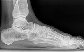 Image result for Calcaneal Apophysitis