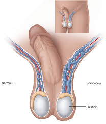 Image result for Varicocele