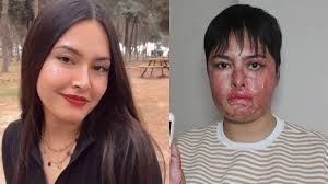 Vücudunun yüzde 80'i yanan Beyzanur: Eski ben değilim artık