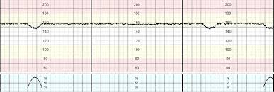 Image result for Structured Intermittent Auscultation