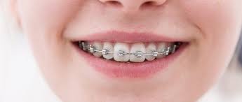 Can someone get braces if they have missing teeth? Braces And Orthodontics In Fort Worth Tx North Texas Smiles