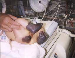 Gram stain and culture of blood and cerebrospinal fluid. Diagnosis And Management Of Neonatal Purpura Fulminans Sciencedirect