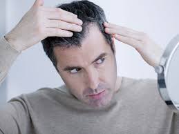 The medical term for the problem is androgenetic alopecia. Conditions That Cause Hair Loss In Men