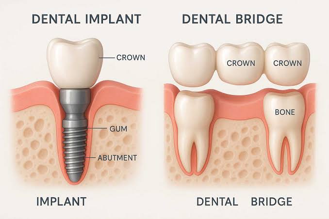 Dental Implants vs Bridges vs Dentures: Which Is Right for You? 2025