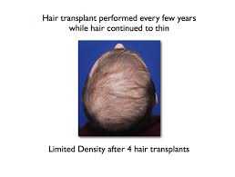 Is it possible to prevent hair loss? Hair Transplant Limitations Ny Hair Loss