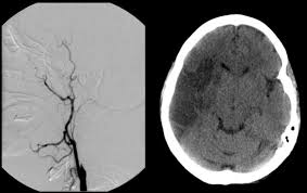 Harinder gill pain & lump: Carotid Artery Dissection 2