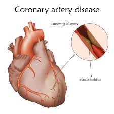 Though clogged arteries are serious, adopting a healthy diet and exercise program can help a lot. Coronary Artery Disease Symptoms Causes Treatment Nh