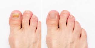 Image result for onychomycosis