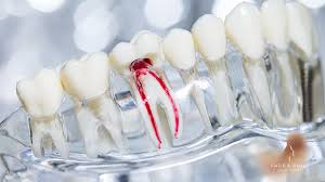 Image result for Tooth Luxation