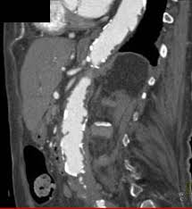 Atherosclerotic Disease With Ulcers In Abdominal Aorta Vascular Case Studies Ctisus Ct Scanning